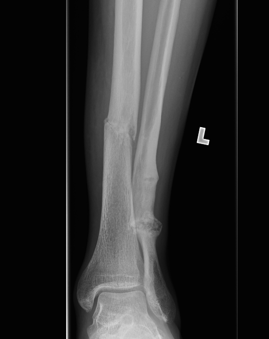 Tibial Stress Fractures The Bone School
